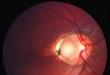 Способ хирургического лечения ямки диска зрительного нерва Ямки диска зрительного нерва